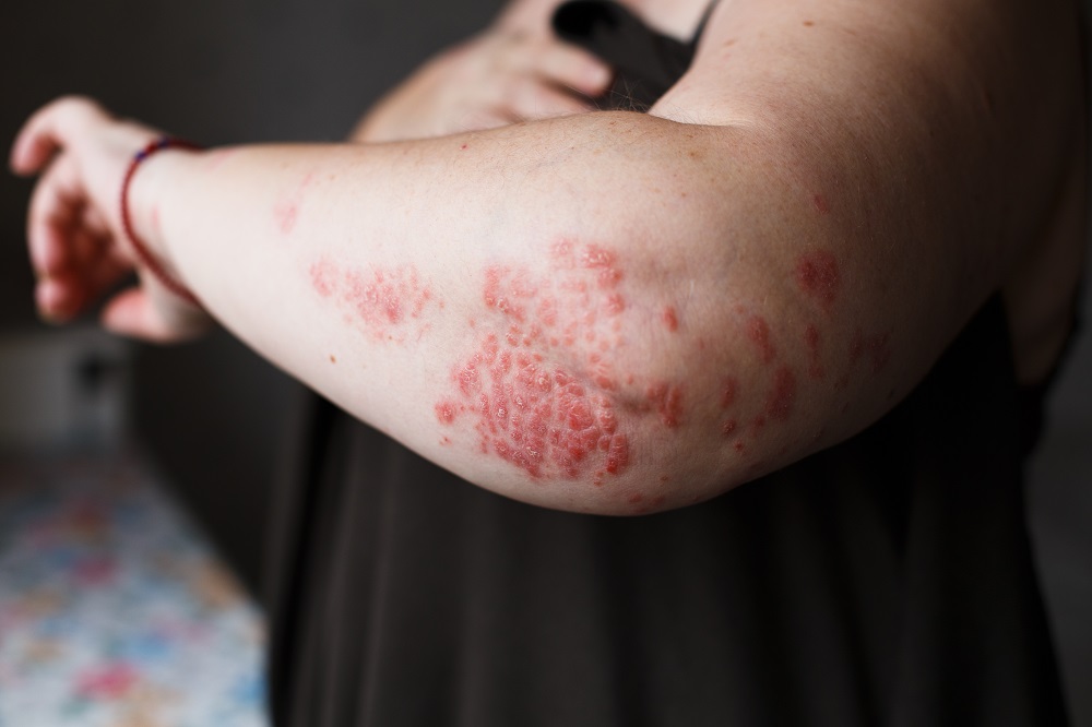 A clinical trial to evaluate lebrikizumab in adult participants with moderate-to-severe Atopic Dermatitis previously treated with Dupilumab.
