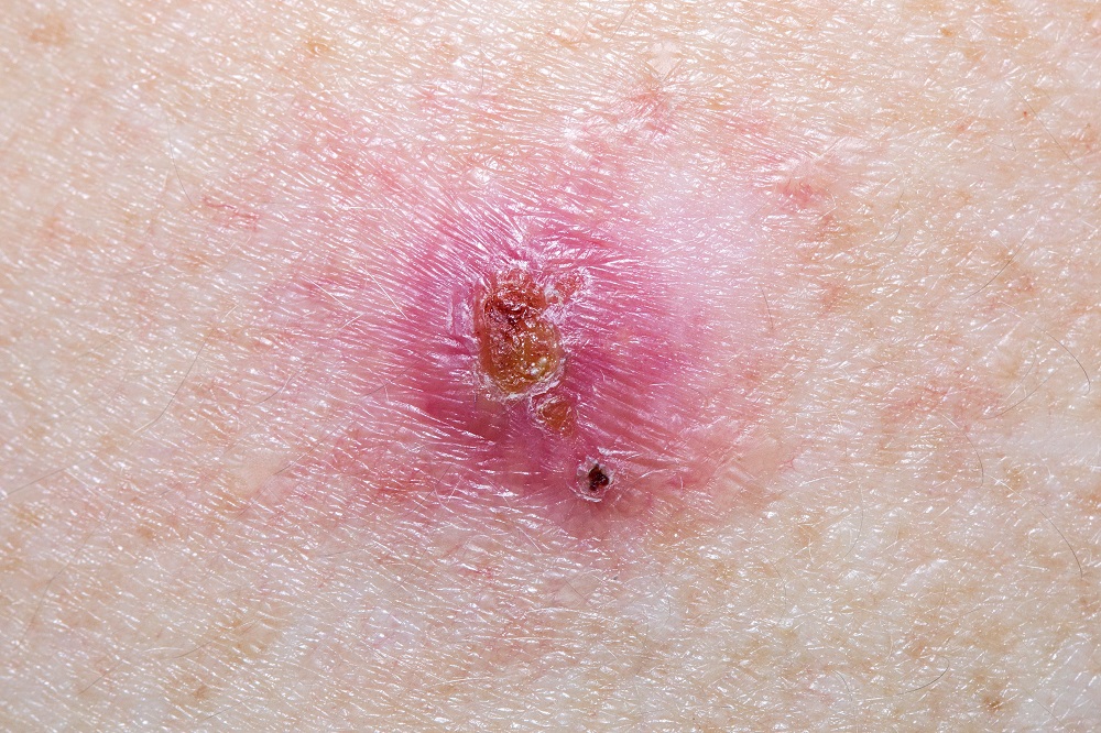 A clinical study of pre-operative Cemiplimab for patients with Cutaneous Squamous Cell Carcinoma or Basal Cell Carcinoma.