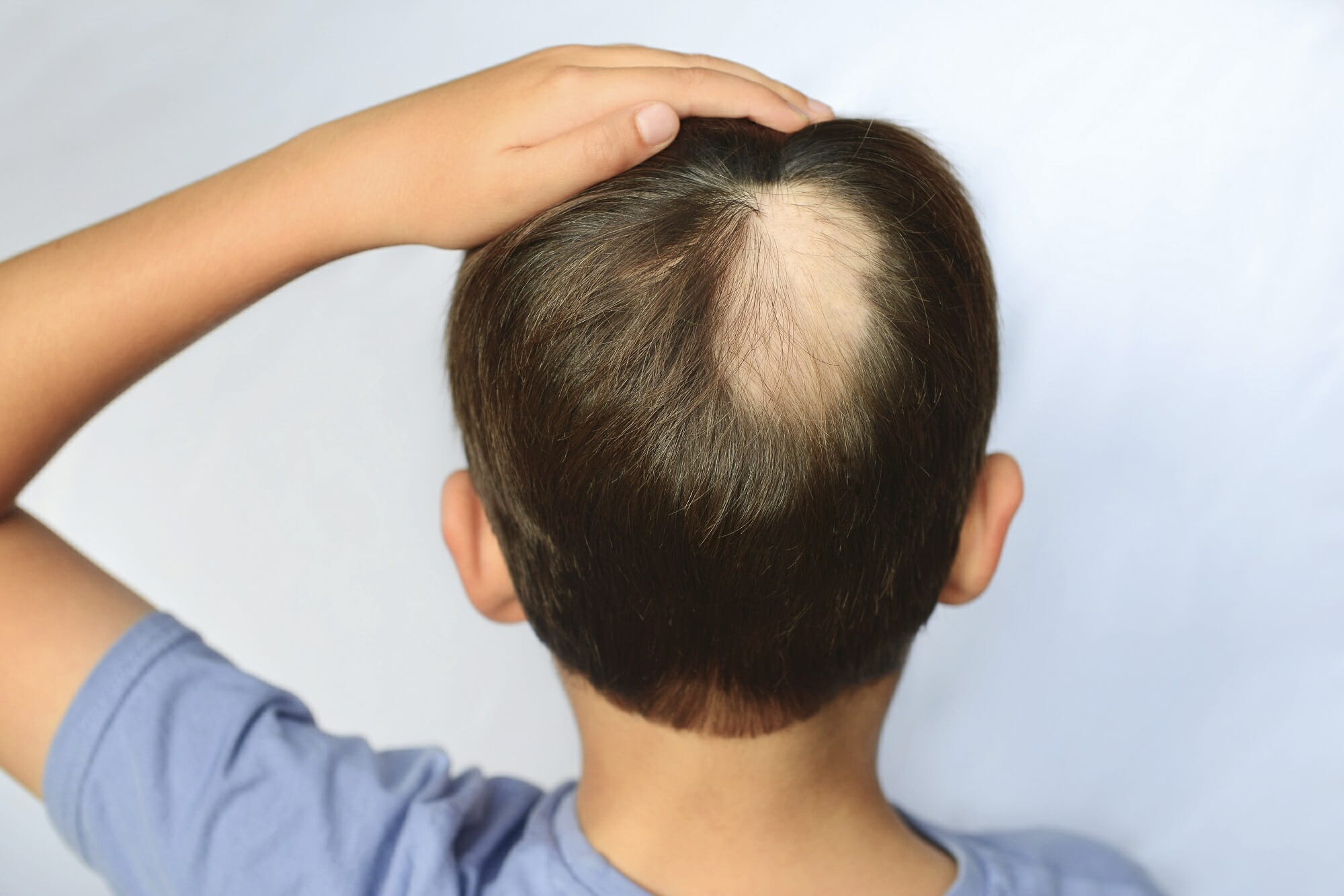 Alopecia Areata Study